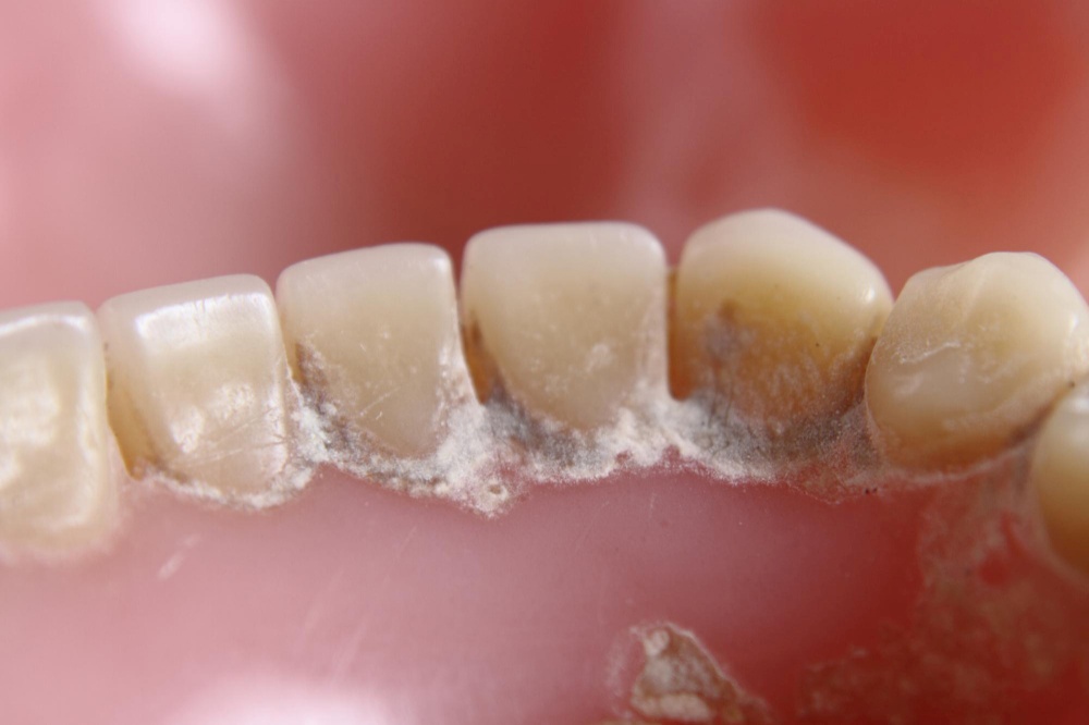 Dicas Essenciais para Prevenir e Combater a Placa Bacteriana