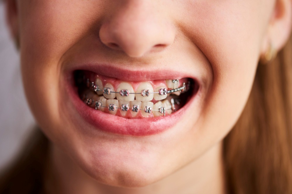 Manutenção de Aparelho Dental: Cuidados Essenciais para um Tratamento Eficiente
