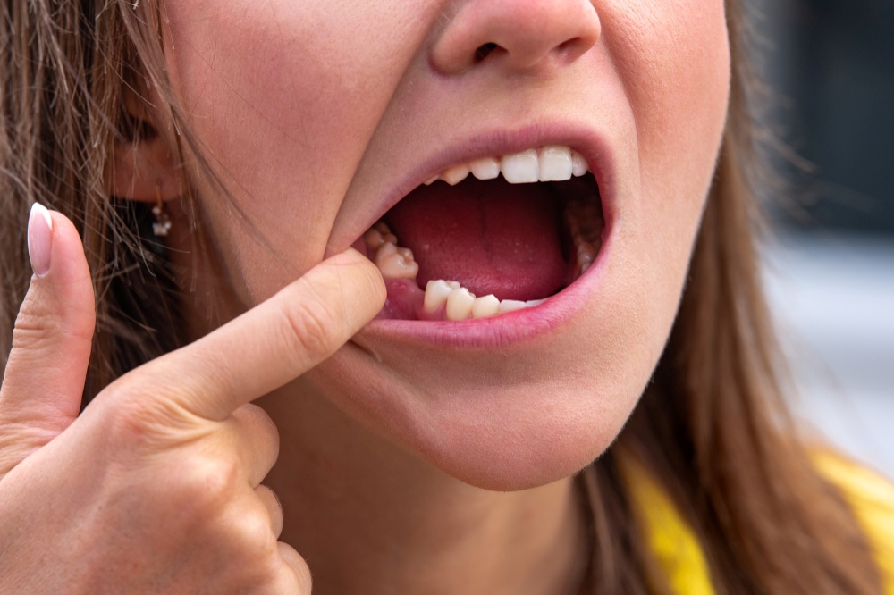 Tratamentos para fratura dentária: soluções para restaurar seu sorriso