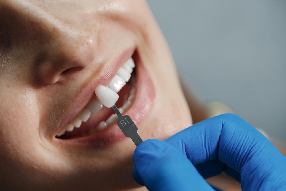 Lente de contato dental: o que é, benefícios e preço do procedimento